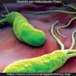 Gastritis por Helicobacter Pylori