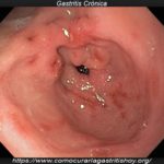 Gastritis Crónica – Consejos y Recomendaciones