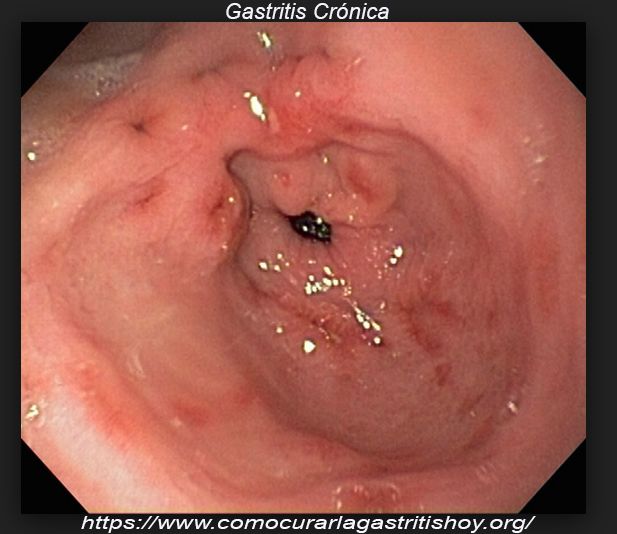 Como eliminar la Gastritis Crónica