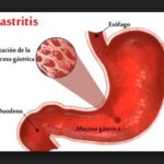Diferencias entre Gastritis y Ulcera Gastrica